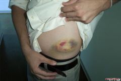 Motorcycle accident 019.jpg