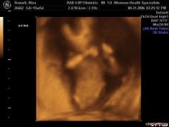16 weeks ultrasound