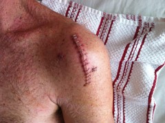 Shoulder surgery - broken scapula & torn rotator cuff