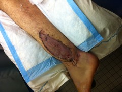 Left leg crushed.  This pic is 3 weeks after plastic surgery skin graft.  Doc says it looks good, but I think it looks gross!