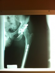 Hip repair