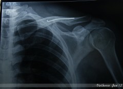 Broken shoulder bone - fixed.