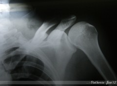 Broken shoulder bone